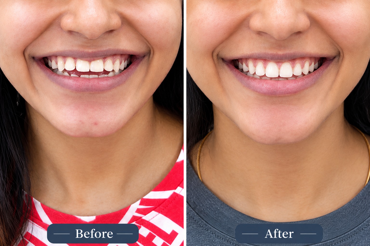 Before and after open bite correction